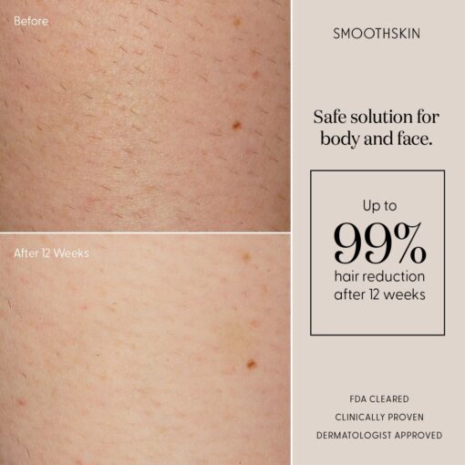 Smoothskin Pure IPL Laser Hair Removal Device for Women & Men, Long-Lasting, for Body, Bikini & Face, Alternative to Laser & Bikini Shaver - Image 4