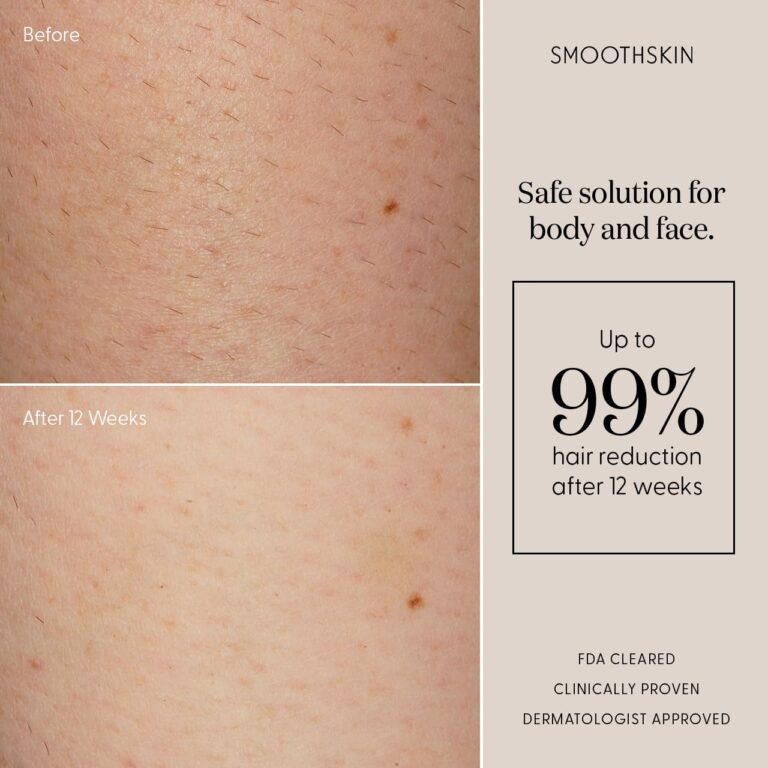 Smoothskin Pure IPL Laser Hair Removal Device for Women & Men, Long-Lasting, for Body, Bikini & Face, Alternative to Laser & Bikini Shaver - Image 4