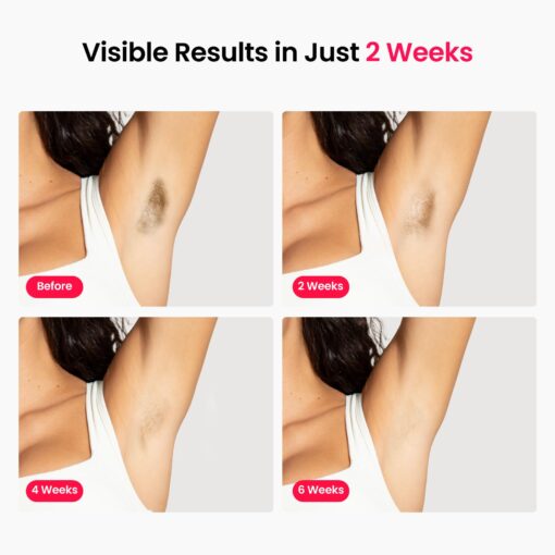 Professional IPL Laser Hair Removal, Super Fast TRIPLE-Pulse, 12 cm² Large Painless Sapphire 37 °F Ice-Cooling Contact, Permanent Hair Removal Device for Women and Men Home, Smart AI, Trinity iGlow 10 - Image 2