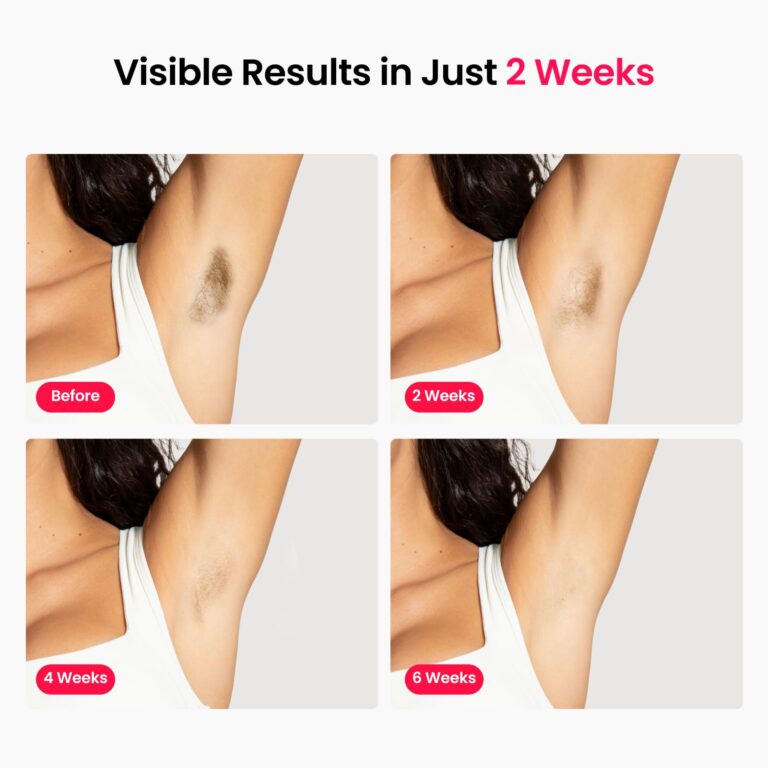 Professional IPL Laser Hair Removal, Super Fast TRIPLE-Pulse, 12 cm² Large Painless Sapphire 37 °F Ice-Cooling Contact, Permanent Hair Removal Device for Women and Men Home, Smart AI, Trinity iGlow 10 - Image 2