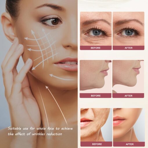 MZONG Non - Wireless RF Skin Rejuvenator - LED Light Combo for Face & Body Wrinkle Reduction - Image 7